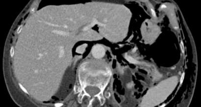 Mistakes in acute abdominal CT and how to avoid them