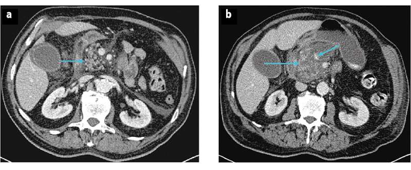 CT scans in a patient with acute pancreatitis