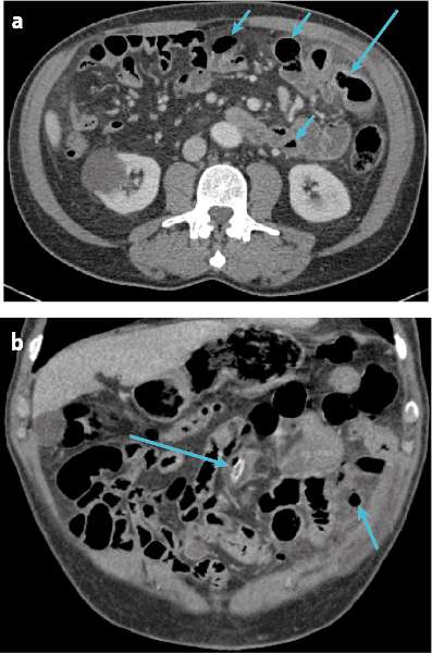 Mistakes in acute abdominal CT and how to avoid them UEG - United European Gastroenterology