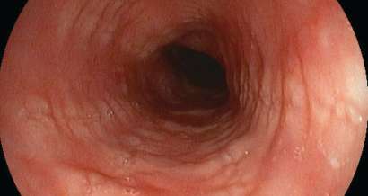 Mistakes in eosinophilic oesophagitis and how to avoid them