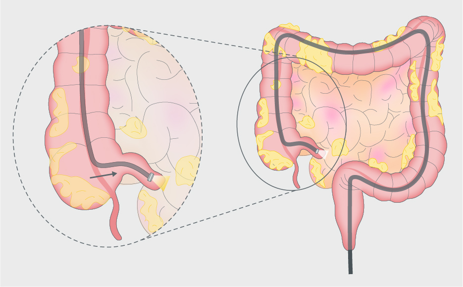 Mistakes in newly diagnosed Crohn's disease and how to avoid them