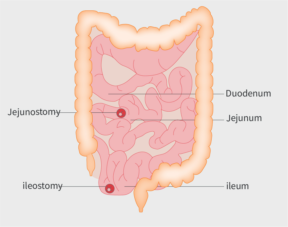 Mistakes in short bowel and how to avoid them