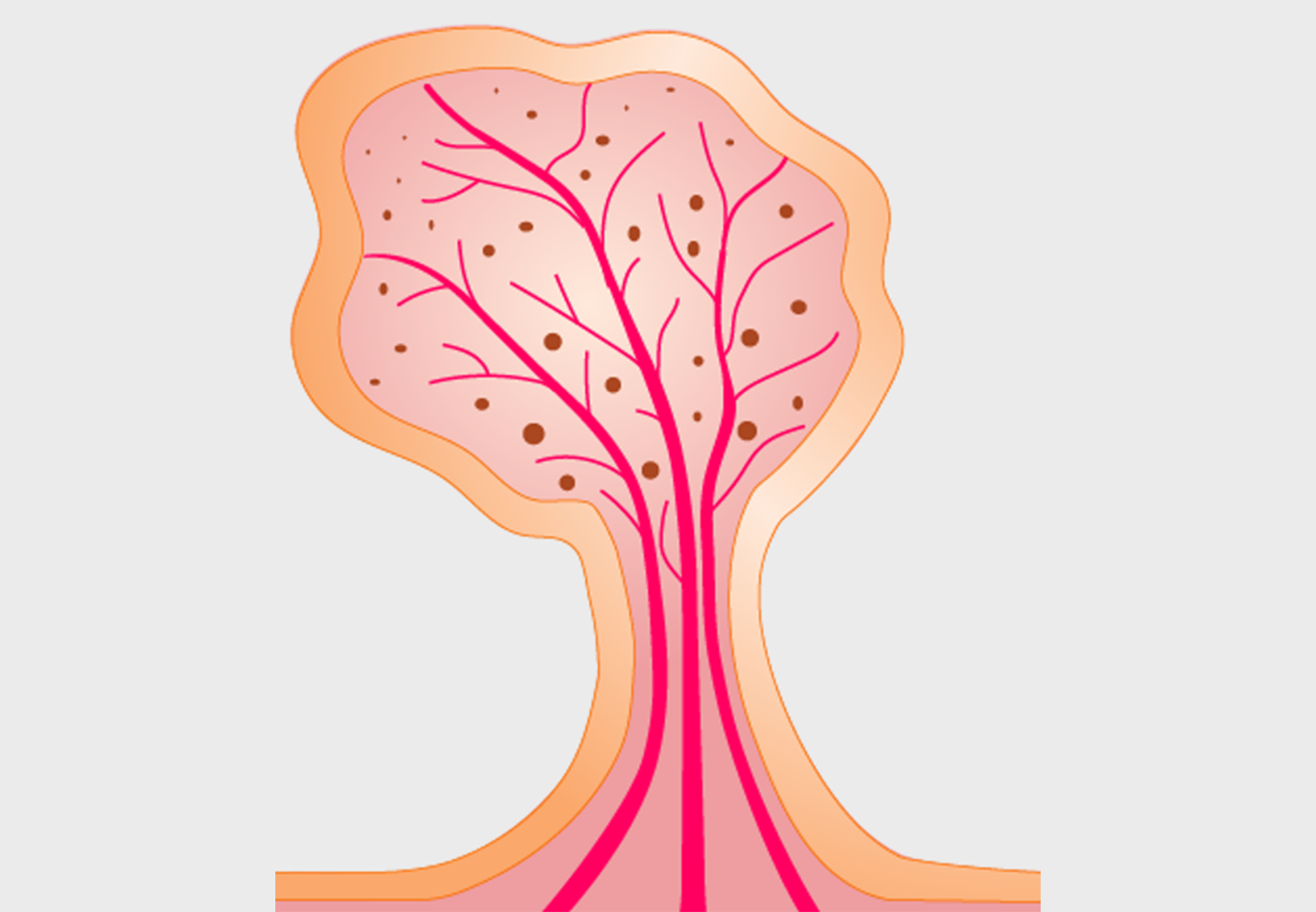 Impact of Polyp Detection in Colonoscopy