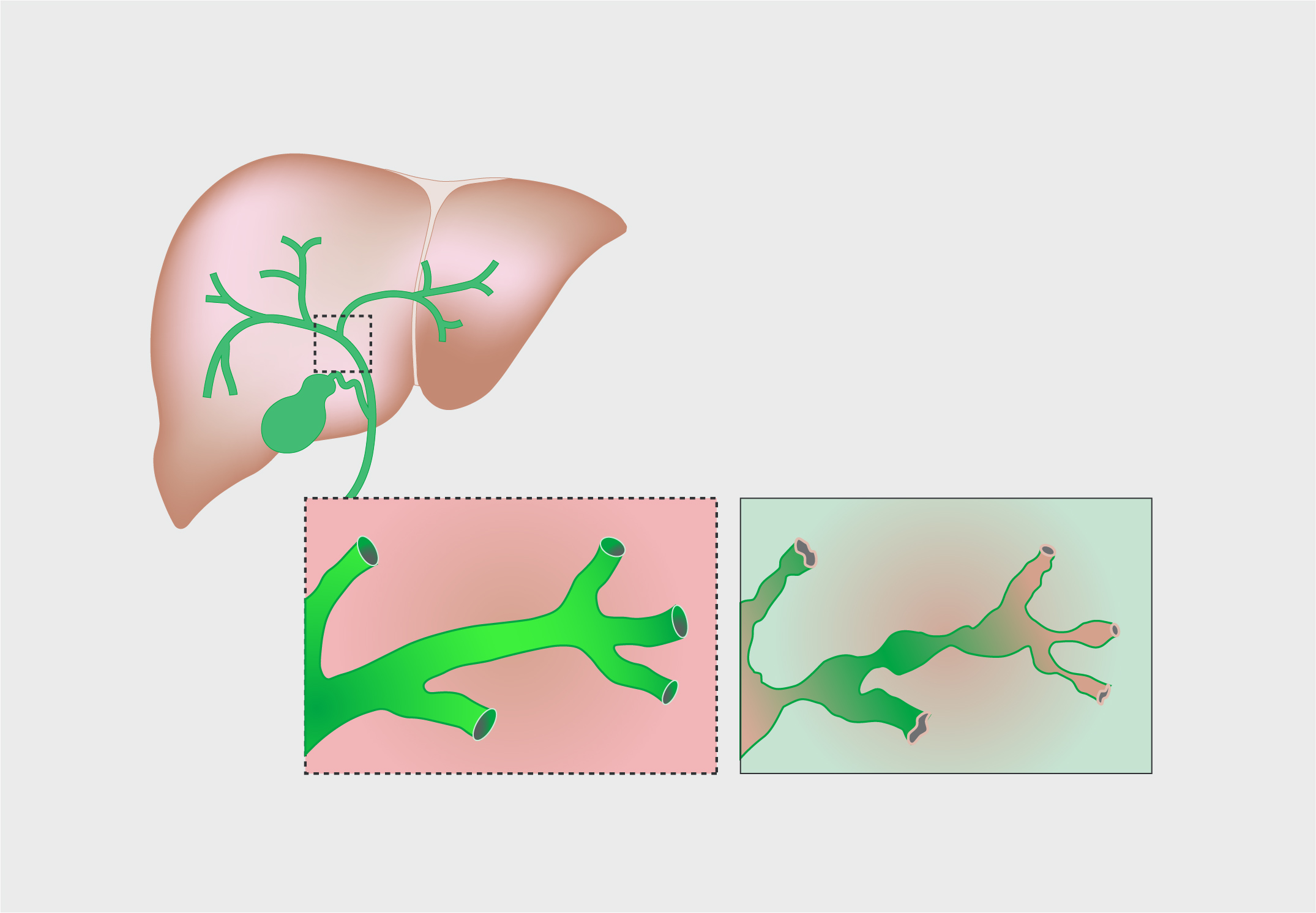 Primary Sclerosing Cholangitis