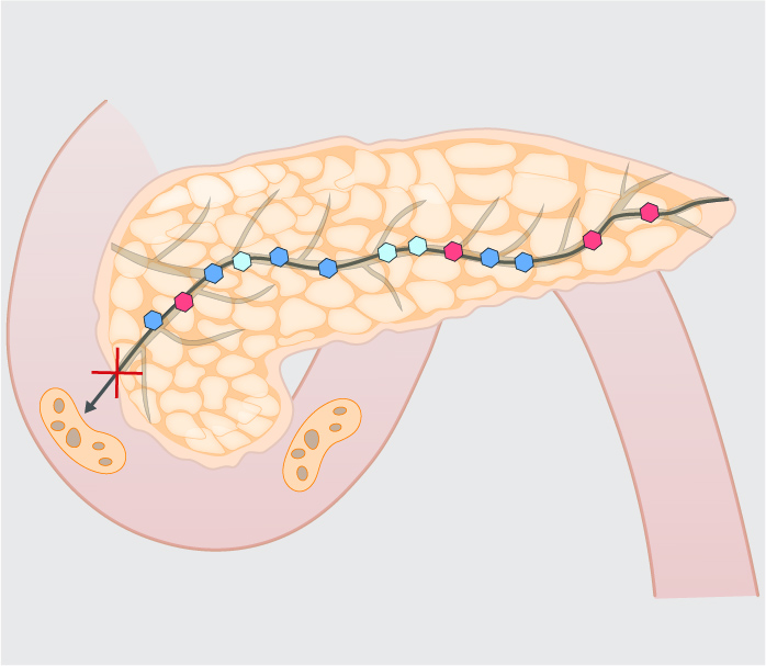 Mistakes in Pancreatic exocrine insufficiency and how to avoid them