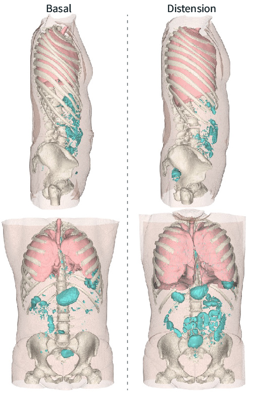 Mistakes in abdominal distension and how to avoid them