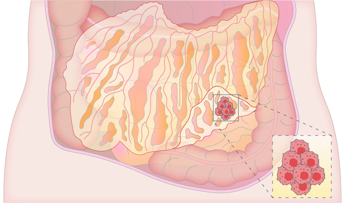 Mistakes in the management of peritoneal malignancies and how to avoid them
