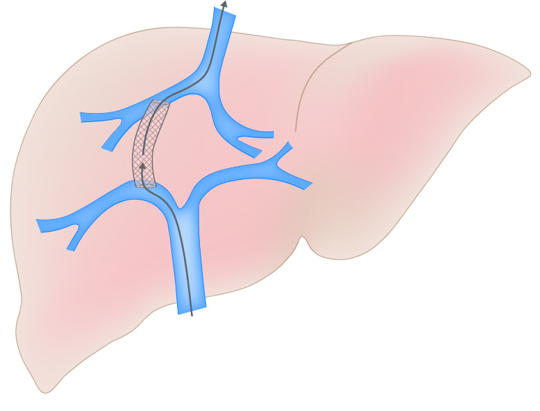 Mistakes in transjugular intrahepatic portosystemic shunt (TIPS) in cirrhosis and how to avoid them