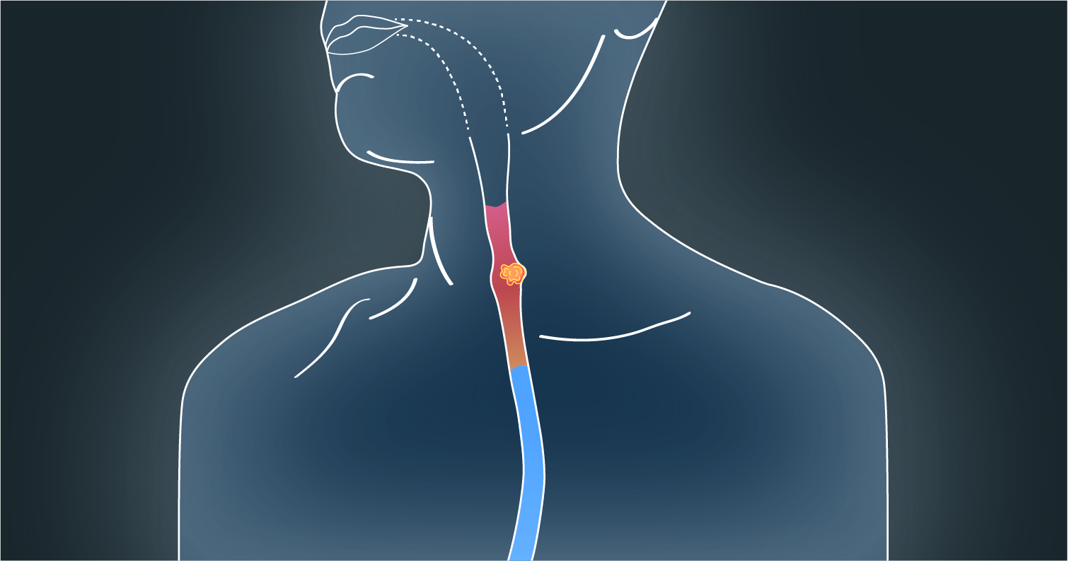 Oesophageal Cancer