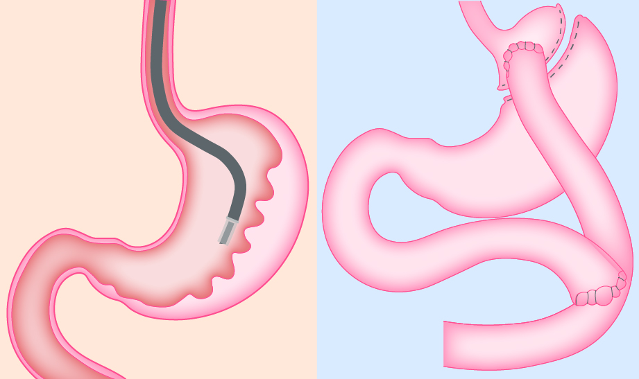 Obesity part 1: Surgical and endoscopic treatment
